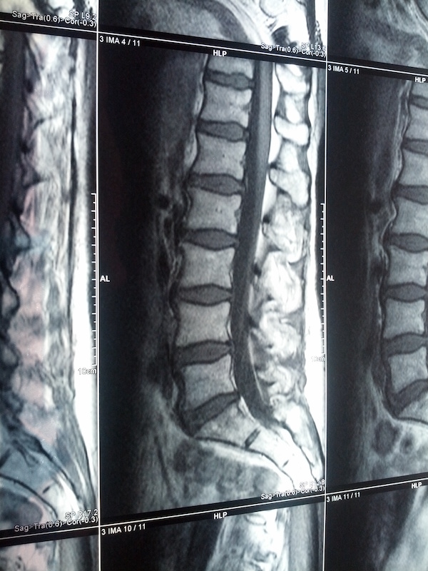 Aufnahmen der Wirbelsäule nach Rückenschmerzen