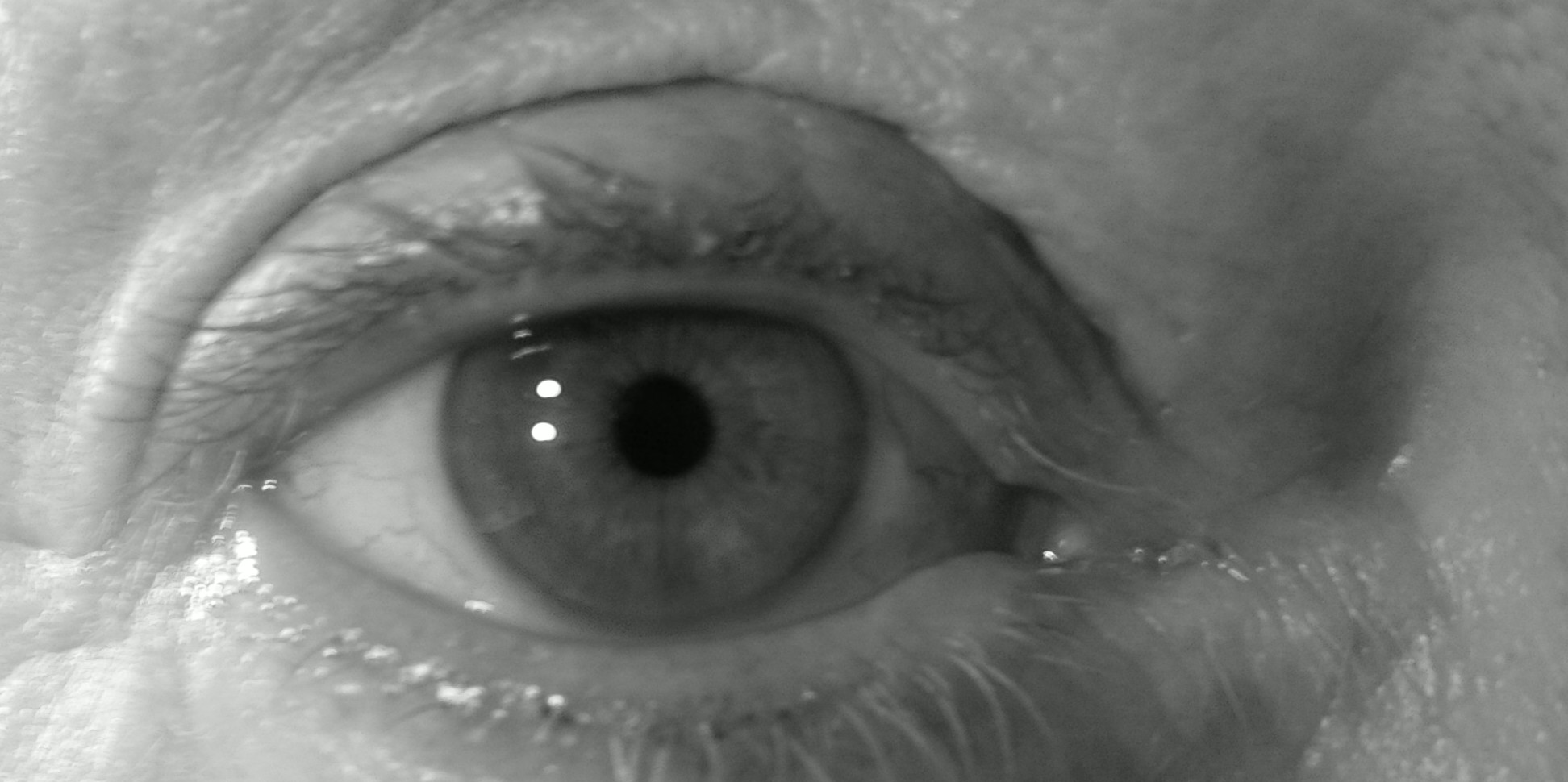 Katarakt-Augenoperation mit Laser