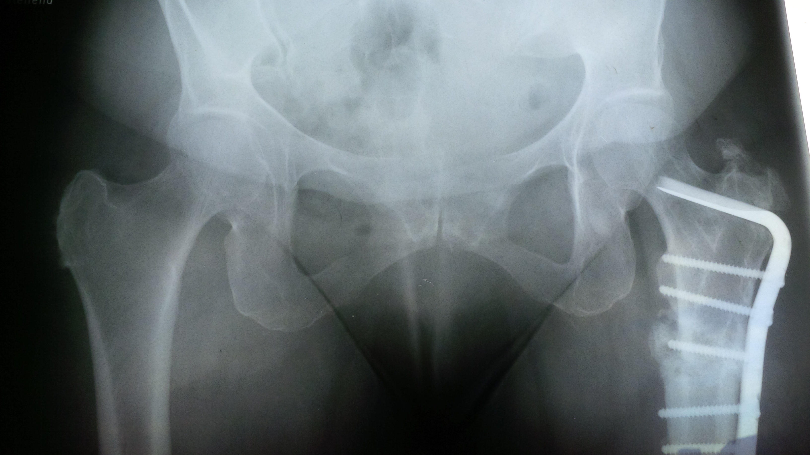Röntgenaufnahme eines gebrochenen Oberschenkelknochens