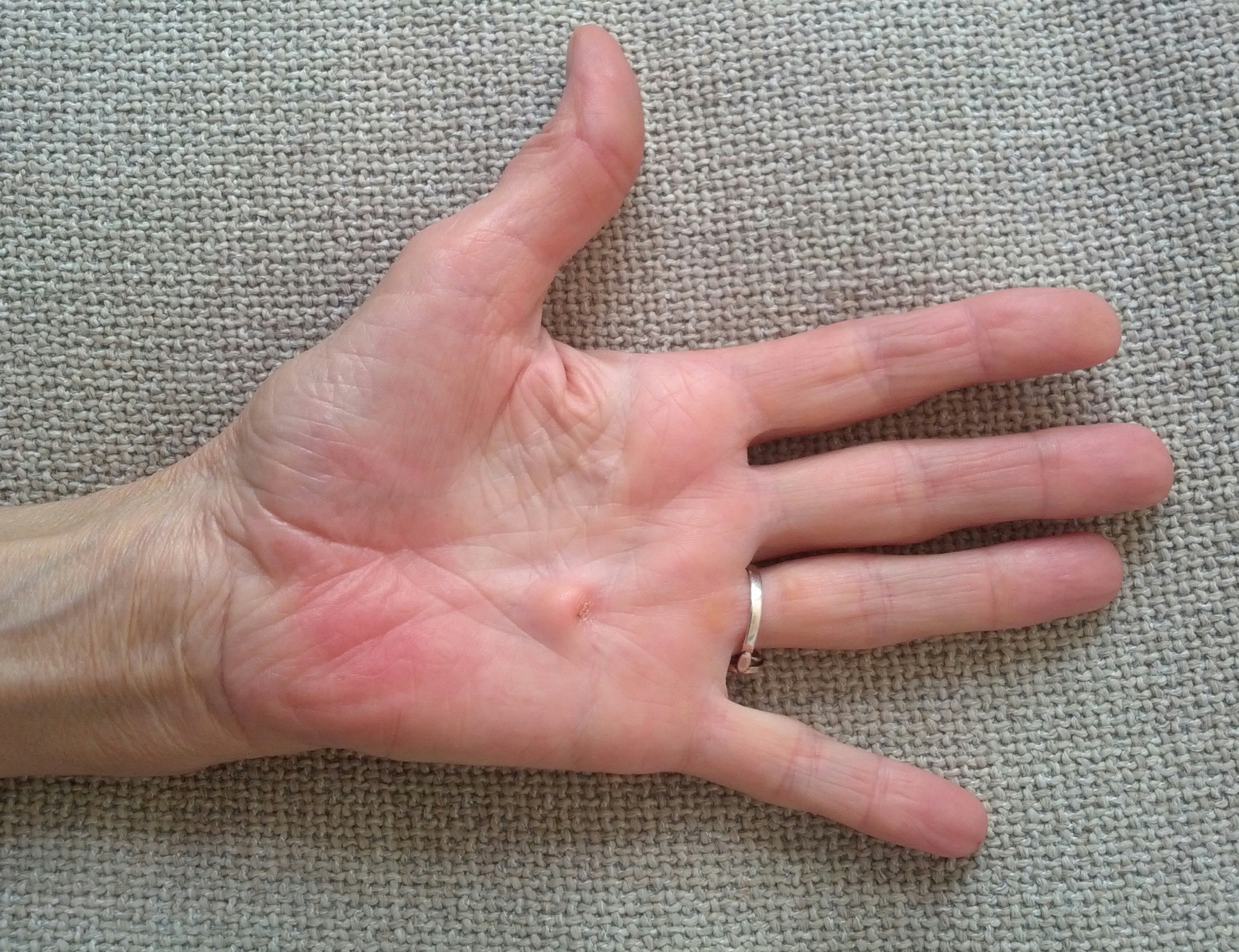 Verlust mehrerer Finger einer Hand wegen Behandlungsfehler